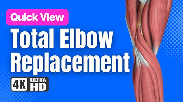 Total Elbow Replacement // See How It Works // 3D Animation.