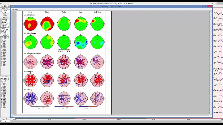 Neurofeedback Loreta Z score