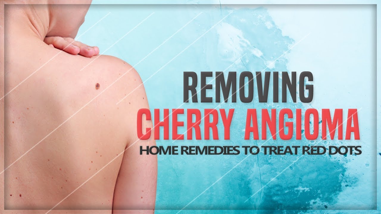 Red Dots On The Skin Removing Cherry Angioma In 4 Easy Home Remedy 