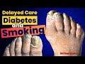 Delayed care diabetes and smoking treating thick fungal toenails