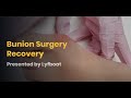 Bunion Surgery Recovery Timeline | Lyfboat