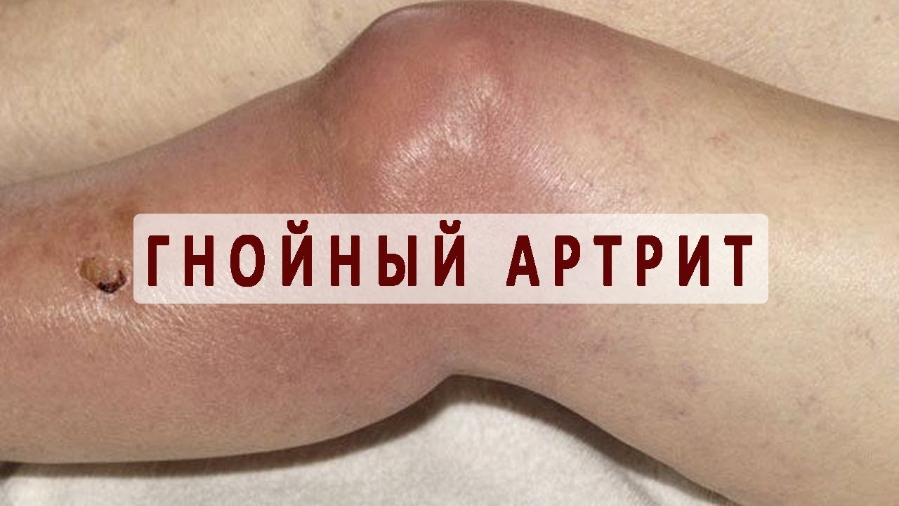 Что такое гнойный артрит?