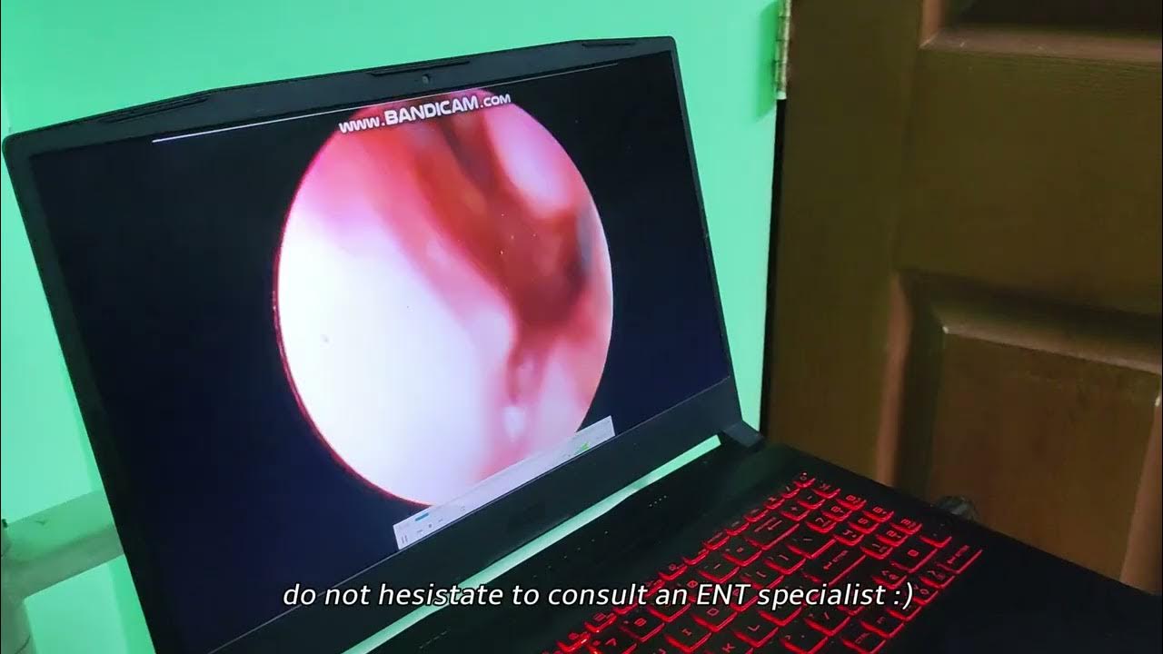 what-s-inside-the-nose-my-nasal-endoscopy-docu-why-is-my-nose-always
