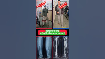 Tibia bone segmental fracture walking full Load bearing #fracturerecovery #fracturetreatment
