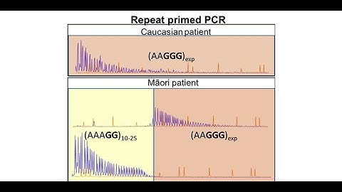 A Māori specific RFC1 pathogenic repeat configuration in CANVAS, likely due to a founder allele
