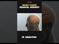 brain tumor removal surgery #medicalshorts #surgery