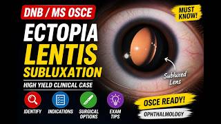 Ectopia Lentis (Lens Subluxation) | DNB/MS Ophthalmology OSCE | High Yield Case