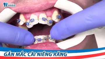 Quy trình gắn mắc cài niềng răng tại Nha khoa Paris