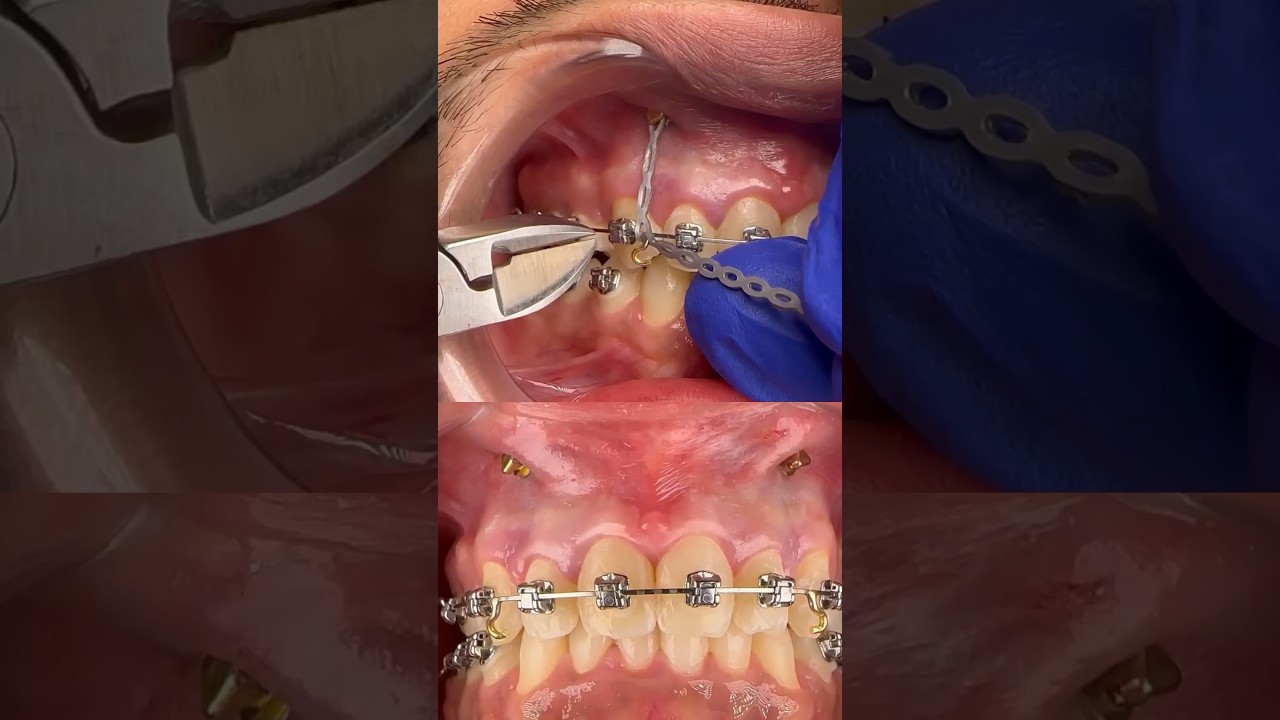 Braces Treatment in India | Magical Results | Dental Braces, Aligner Procedure 