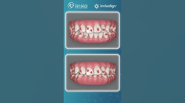 Răng chen chúc, cắn sâu niềng răng invisalign được k? #nhakhoavietssmile #niengrang B.V. Nam S3494