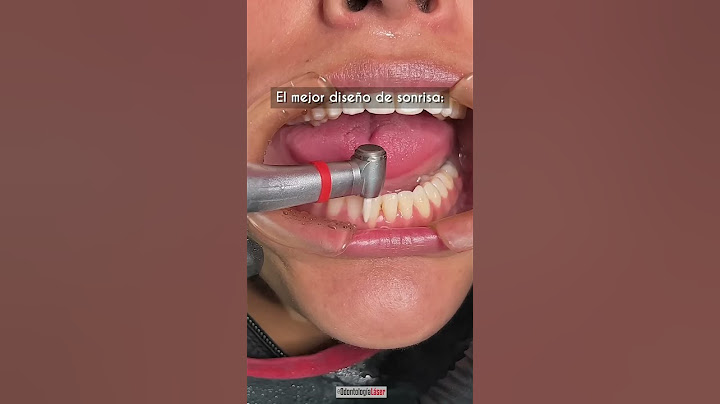 El mejor diseño de sonrisa / Adiós Brackets - Odontología Láser #Shorts