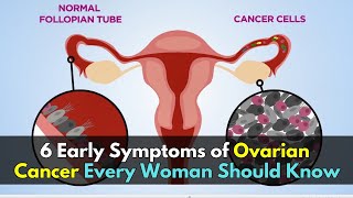 6 Early Symptoms of Ovarian Cancer Every Woman Should Know