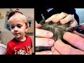 HEAD STAPLE REMOVAL GONE WRONG!  | Dr. Paul