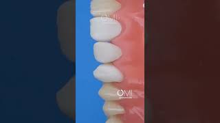 Dental Motivation. Direct Composite Restoration Teeth. Front Teeth Restoration