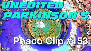 Phaco Clip #153 - WEDGE On Parkinson's