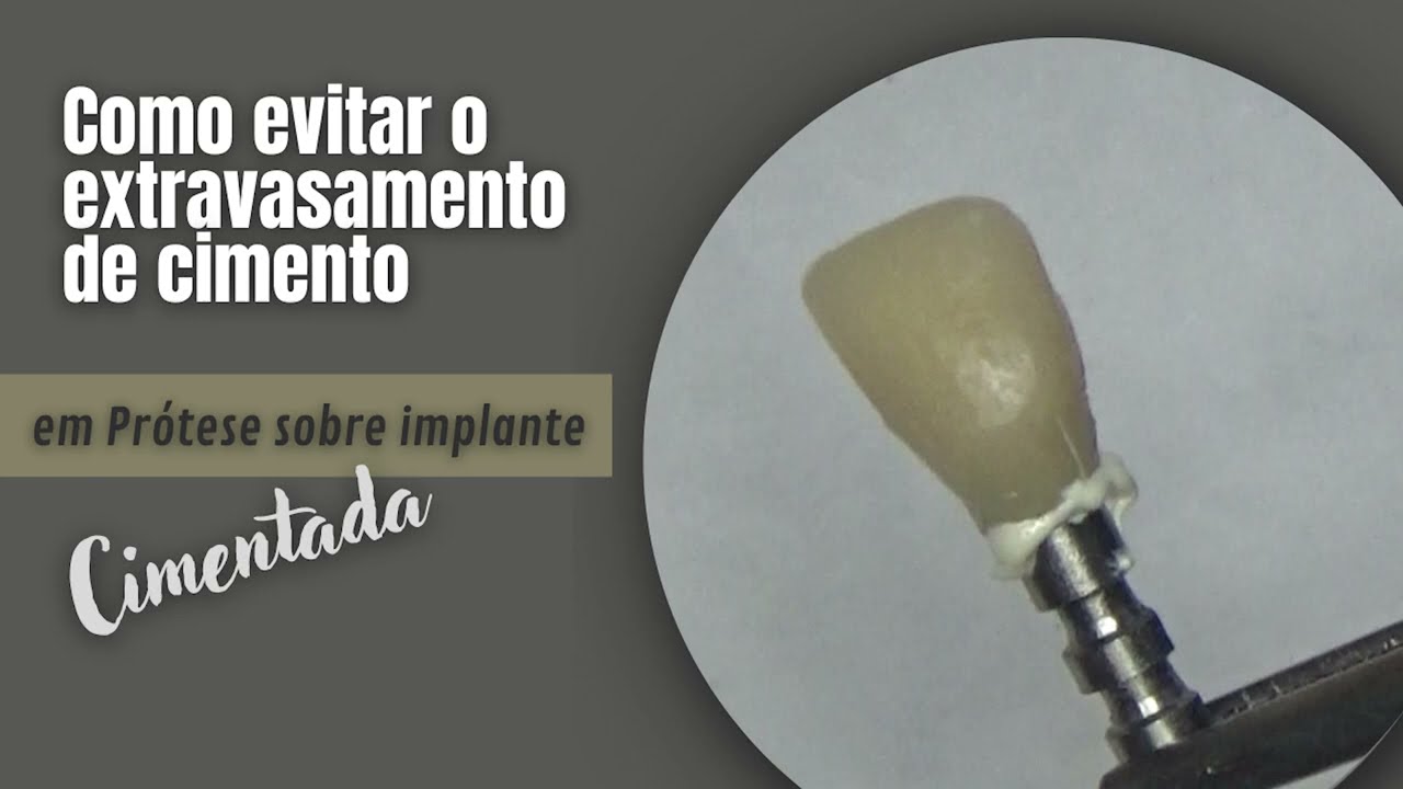 Como evitar o extravasamento de cimento em prótese sobre implante cimentada!