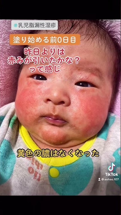 乳児湿疹ステロイド2日目 Youtube