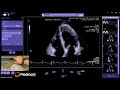 Piedmont Healthcare Left Ventricle Myocardial Strain Workflow on Siemens SC2000