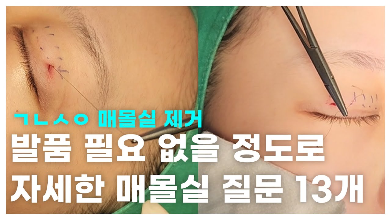 [Ганнам Соён Гоо сайхны мэс заслын эмнэлэг] Гоо сайхны мэс заслын судалгаа I: Зөвлөгөө авах, газар хайж явах шаардлагагүй болтол дэлгэрэнгүй оёх аргын тухай 13 асуултын бүрэн