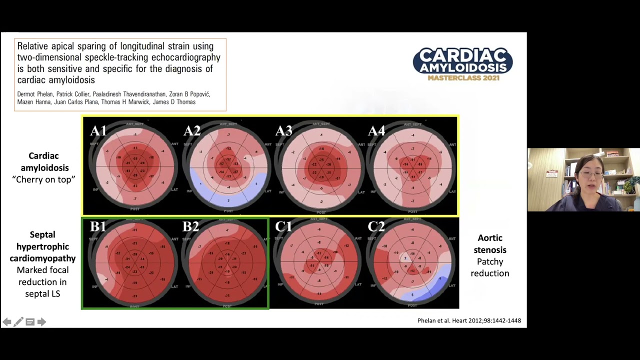 global longitudinal strain amyloidosis