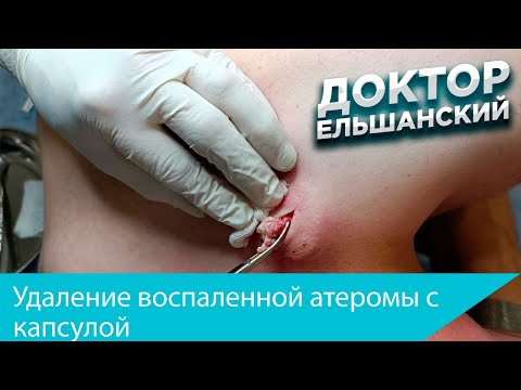 Удаление воспаленной атеромы с капсулой