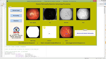 Diabetic Retinopathy Detection Using Matlab