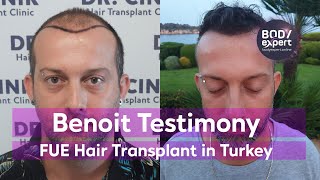 FUE Hair Transplant in Turkey [Benoit Testimony]