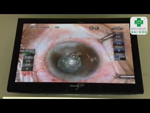 Phẫu thuật PHACO  - mổ thay thủy tinh thể tại Bệnh viện mắt Sài Gòn