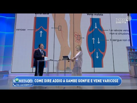 Video: Gonfiore Delle Gambe Con Insufficienza Cardiaca: Trattamento Domiciliare