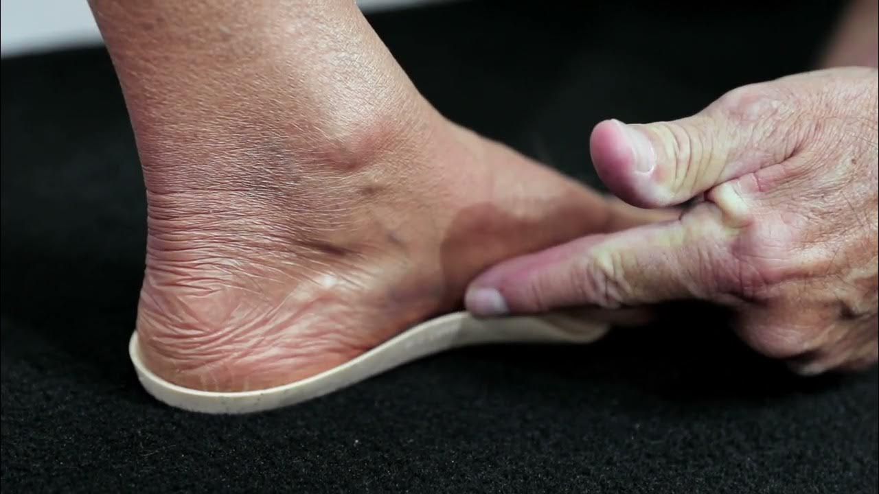 How Natural Foot Orthotics helps Back Pain YouTube