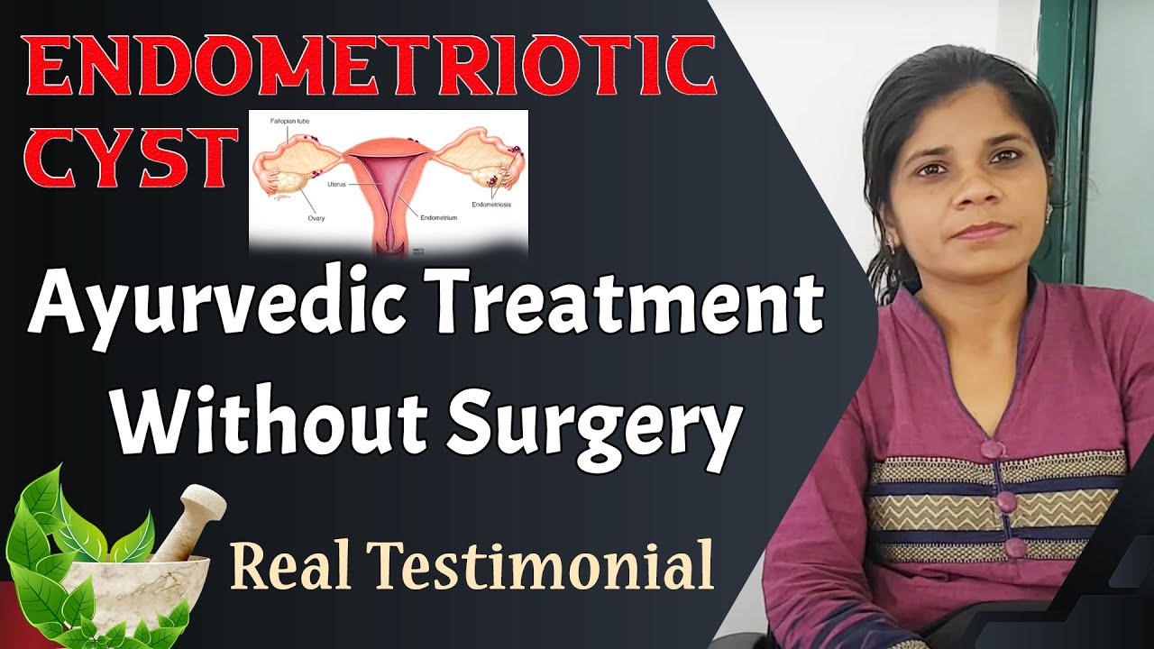 Endometriotic Cyst Ayurvedic Cure Without Surgery Real Testimonial