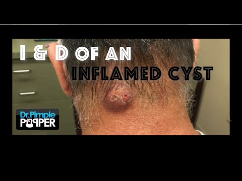 ingrown hair cyst neck