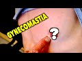 TEENAGER HAS A LUMP UNDER HIS NIPPLE... (Gynecomastia) | Dr. Paul