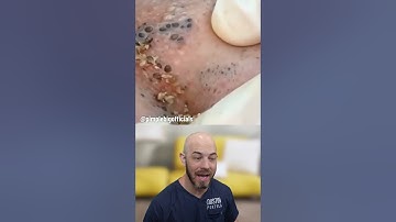 Dozens and dozens of blackheads on the face 😰 (credit: @pimplebigofficials on TT) #fyp #reaction