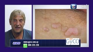 Hablemos de Salud Uruguay:Berrugas Genitales. Dr Ariel Luksenburg.GYCO
