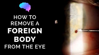 How To Remove A Foreign Body From The Eye | Eye Injury | Osce Guide | Ukmla | Cpsa