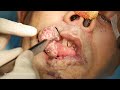 Large Cavernous Hemangioma of lower lip Surgery - Dr. Sunil Richardson