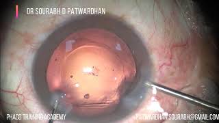 Posterior Polar cataract- method,Rent,PCCC and IOL in the bag