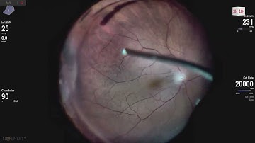 FTMH ILM peeling with yellow endo illumination Ophthalmic surgery live 18+ Lukan Mishev