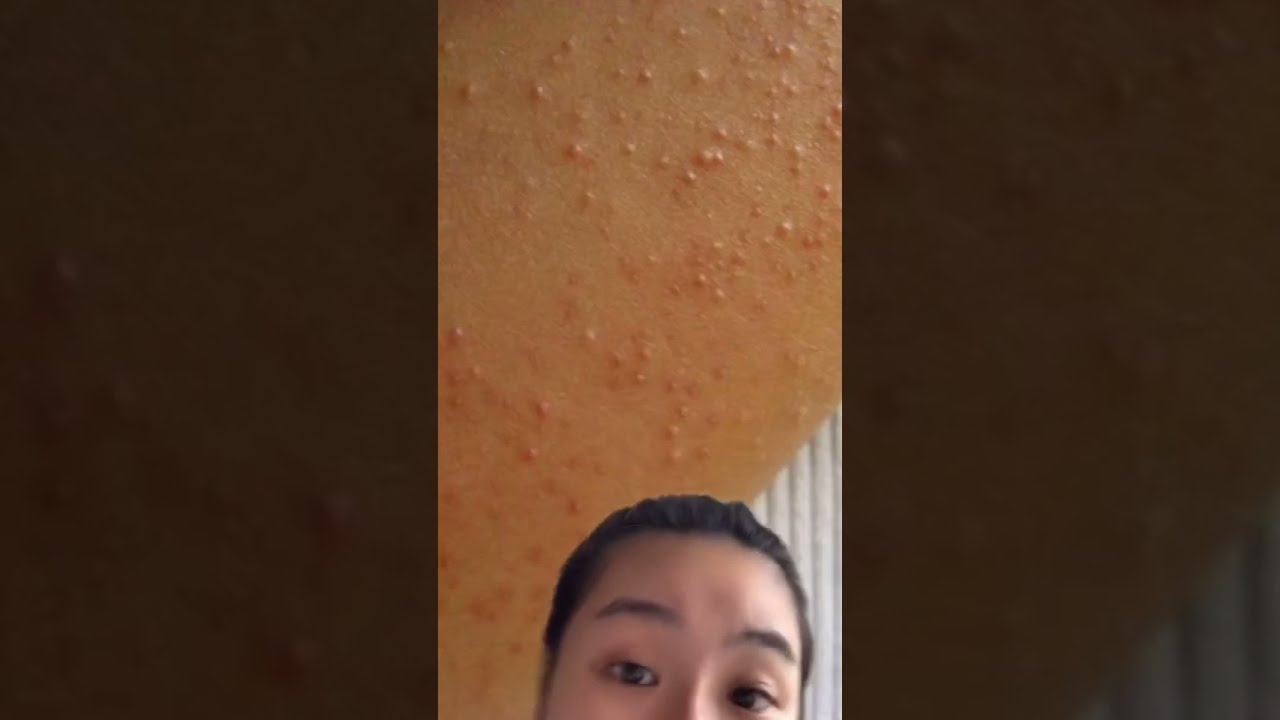If You Suffer From Keratosis Pilaris Aka Chicken Skin Watch This Now