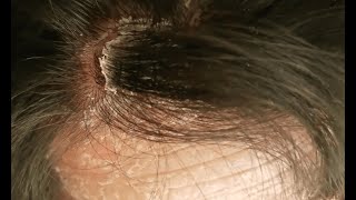 Soothing Sound of Psoriasis