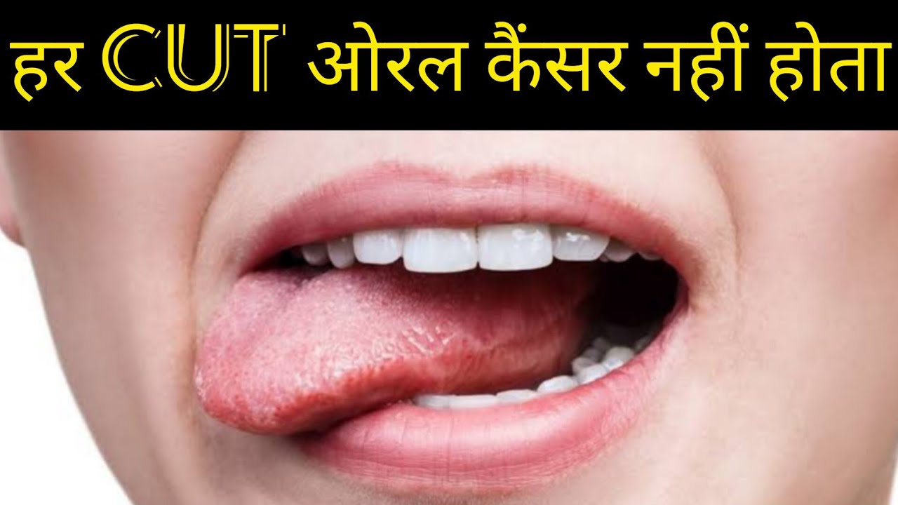 ORAL CANCER से कैसे बचायें खुद को। HEALTH।MEDICINE। DENTAL HYGIENE
