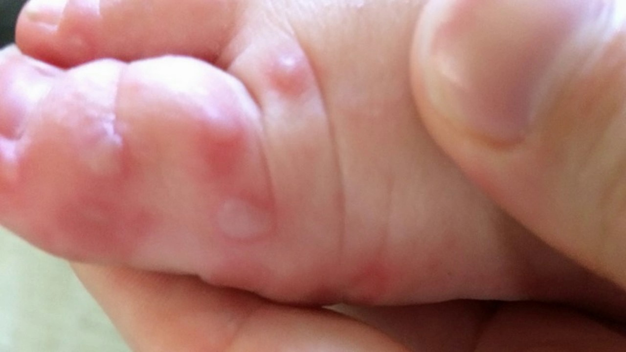 Difference Between Chickenpox and Hand Foot and Mouth 