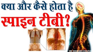 क्यों और कैसे होता है स्पाइन टीबी ? // What Causes TB of the Spine ? // Dr. Sourabh Chachan screenshot 5