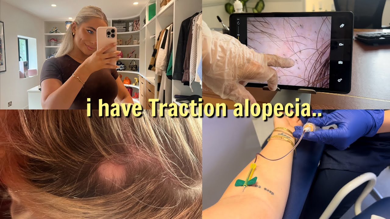 I have traction alopecia.. | Saffron Barker