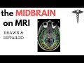 Neuroanatomy on MRI Part 2 | Hypothalamus & Midbrain tectum, tegmentum & floor