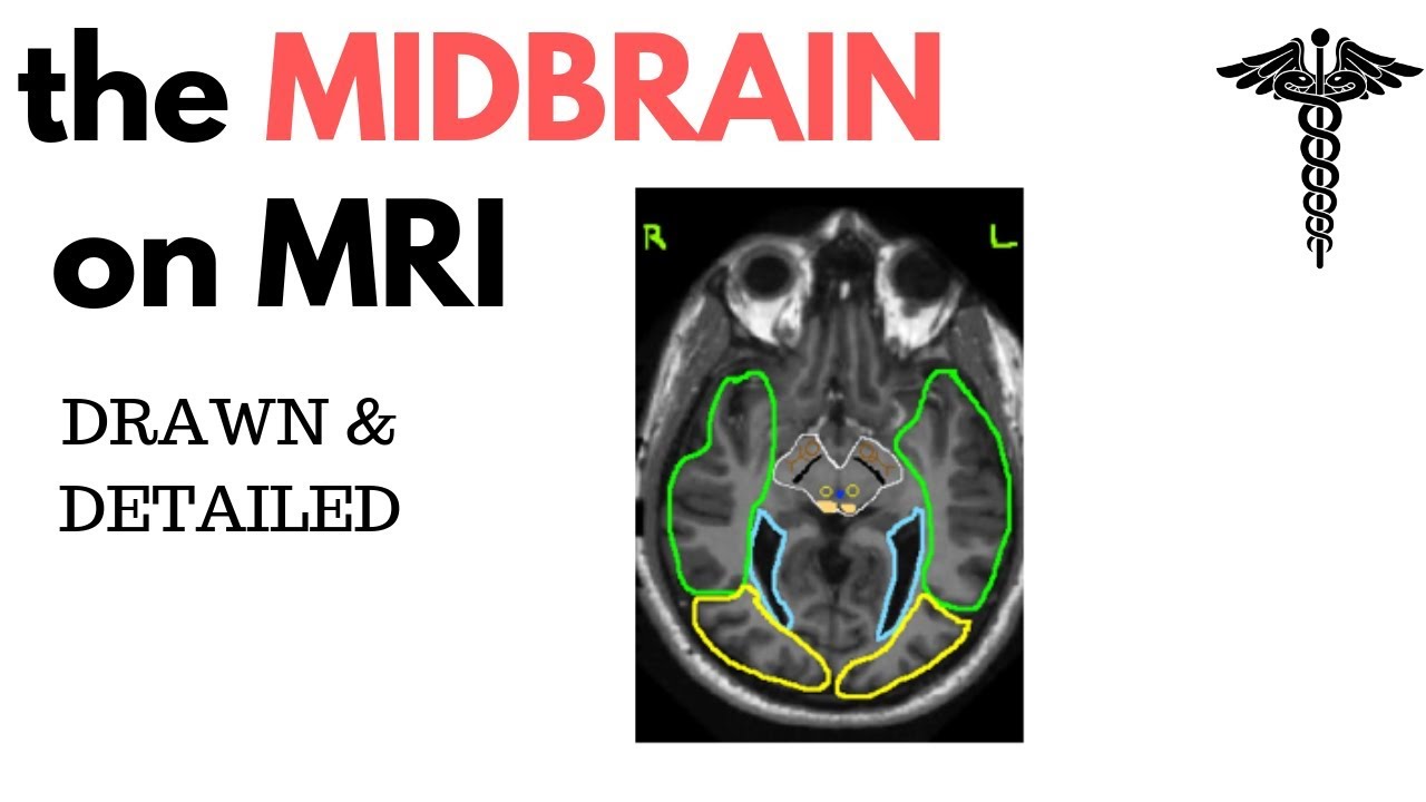 Neuroanatomy On MRI Part 2 Hypothalamus Midbrain Tectum Tegmentum neuroanatomy-on-mri-part-2-hypothalamus-midbrain-tectum-tegmentum