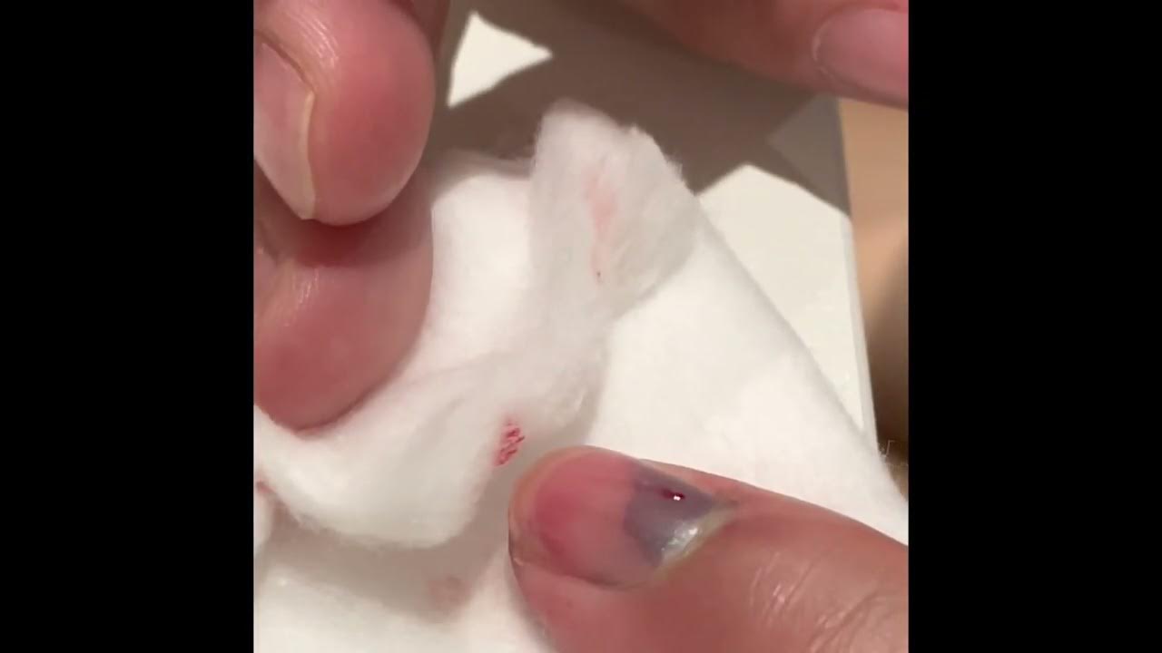 how-to-drain-blood-under-your-nail-i-did-this-after-i-accidentally