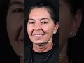 Full Mouth Dental Implant Transformation UK | Banning Dental Group London | Implant Before & After