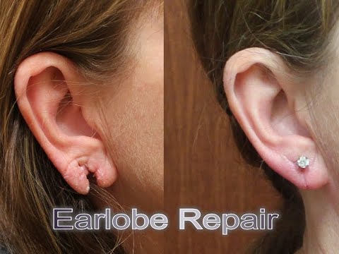ripped-stretched-split-injured-torn-earlobe-repair-with-laser-plastic-surgery-sugar-land-houston-tx